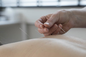 IBC-acupunctuur